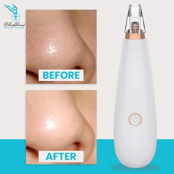 Blackhead Remover Vacuum