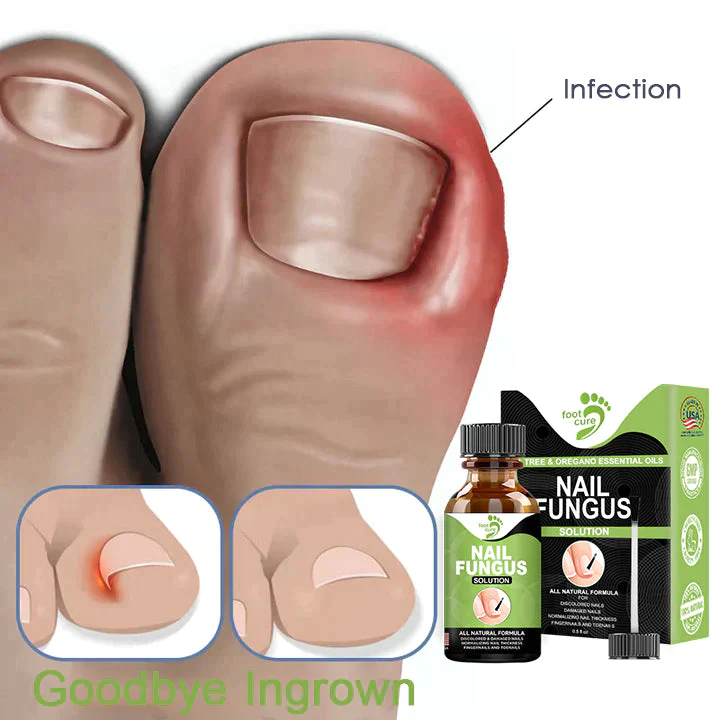 FOOTCURE Removal Paronychia Gel