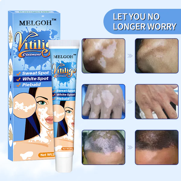 Melgoh Clinically Proven Vitiligo Ointment