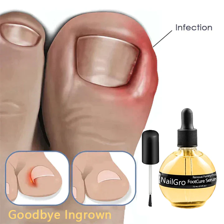 NailGro FootCure Removal Paronychia Serum