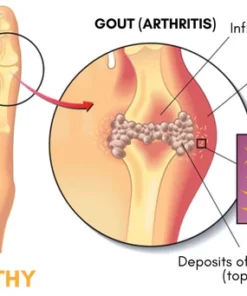 AcuHealth Gout Aid Toe Rings