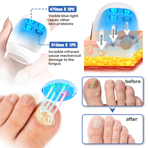 Furzero Nail Fungus Cleaning Laser Relief Device