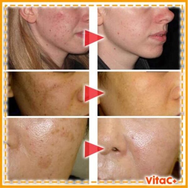 VC Whitening Freckle Serum