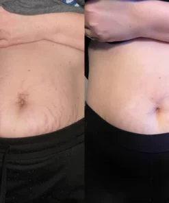 AEXZR Stretchmark Repair Cream