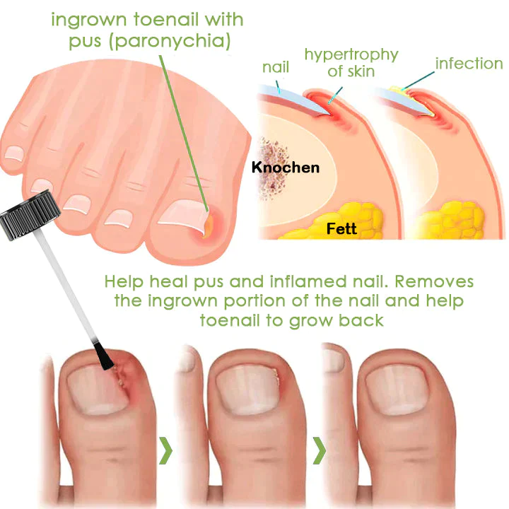 FOOTCURE Removal Paronychia Gel