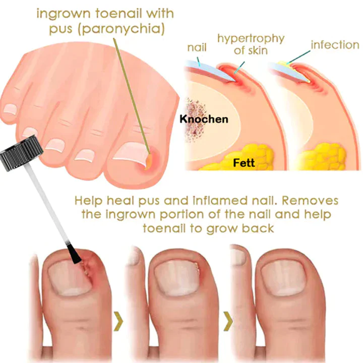 NailGro FootCure Removal Paronychia Serum