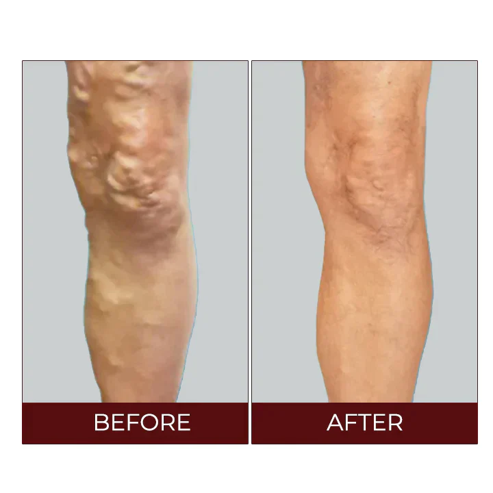 Oveallgo Varicose Veins Relief Cream