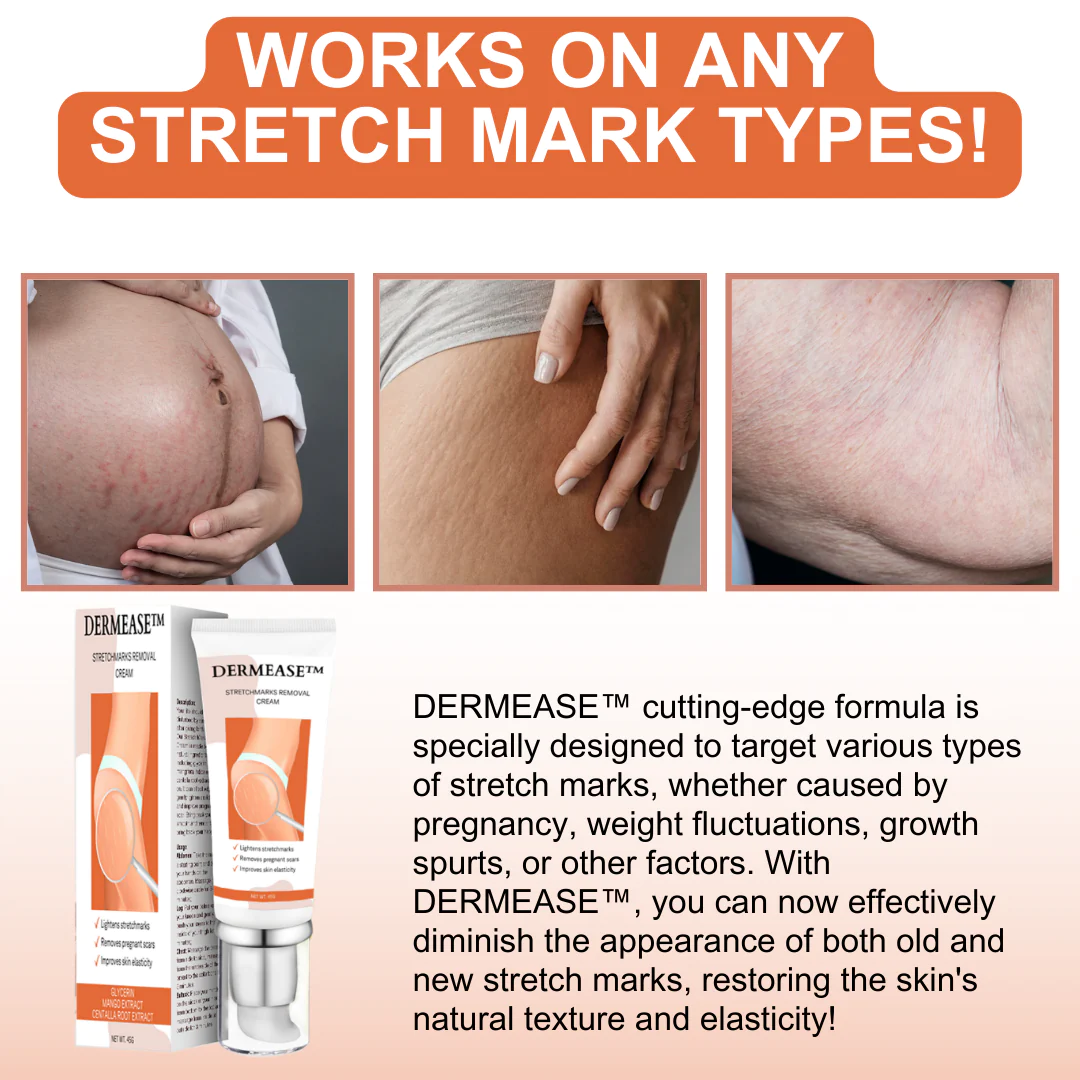 DERMEASE Stretchmarks Removal Cream