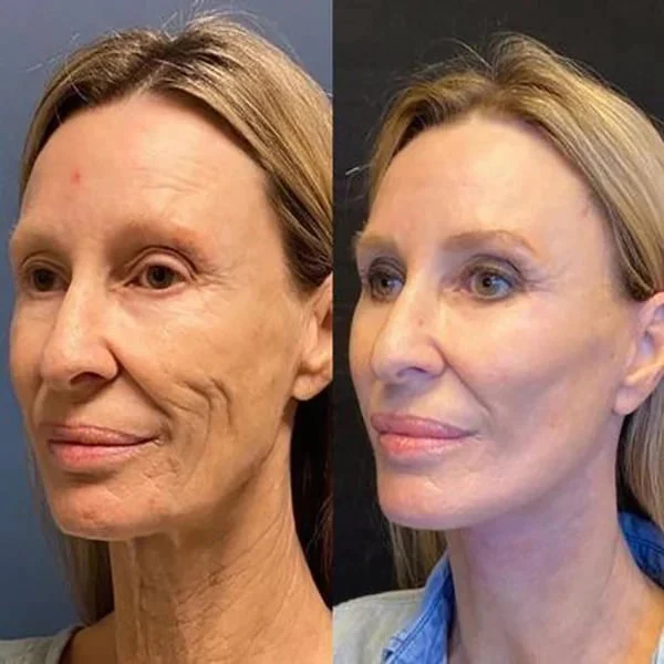 Jorondy Botox Facial Essence