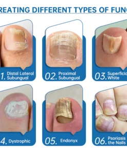 Furzero Highly Effective Onychomycosis Machine laser device