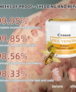 Cvreoz Bee Venom Psoriasis Treatment Cream