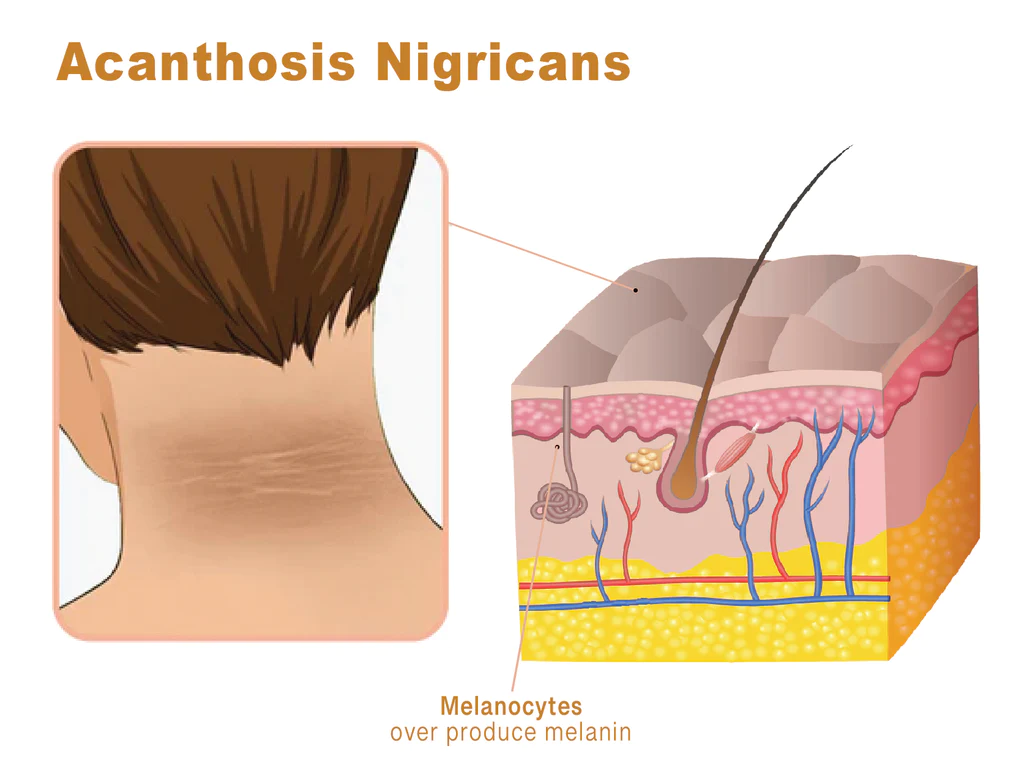 AcanthoGlow Therapy Cream