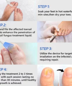 Furzero Toenail Fungus Laser Treatment Devices