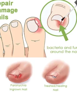 FOOTCURE Removal Paronychia Gel