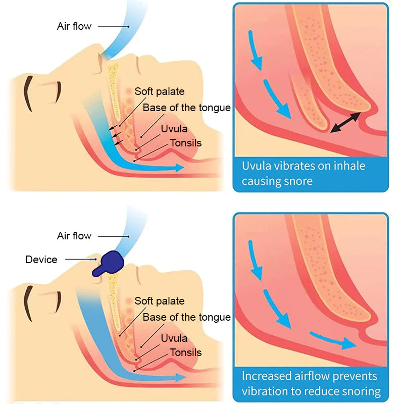 Electric Well Sleep ApneaStop Device