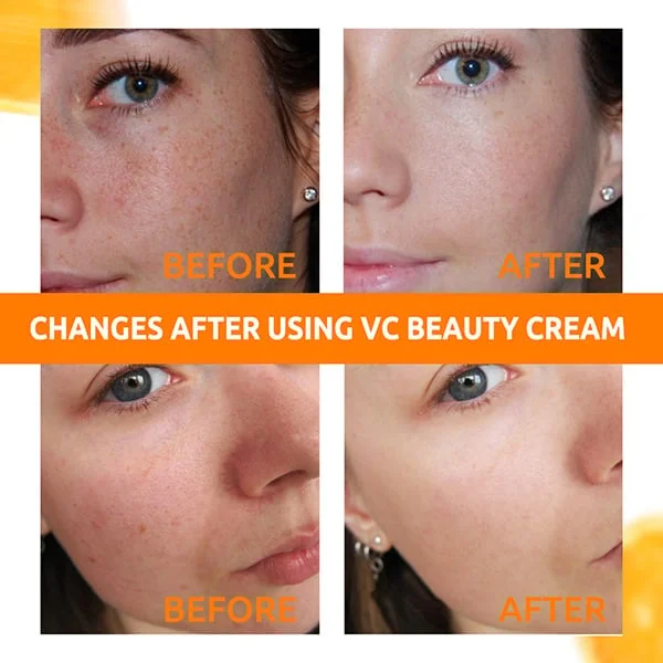 Vitamin C Freckle Dark Spot Removal Cream