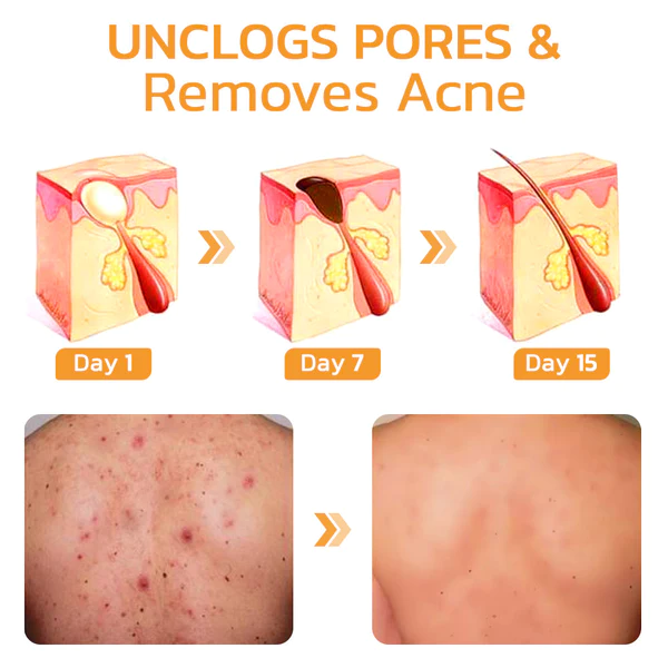 GFOUK FAFASKIN Psoriasis, Acanthosis Nigricans & Acne Cleanser