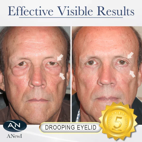 ANewI Pro Eye-Lift Depuffing Gel