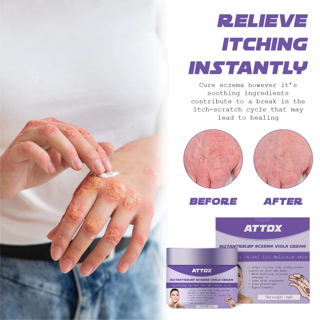 ATTDX InstantRelief Eczema ViolaCream