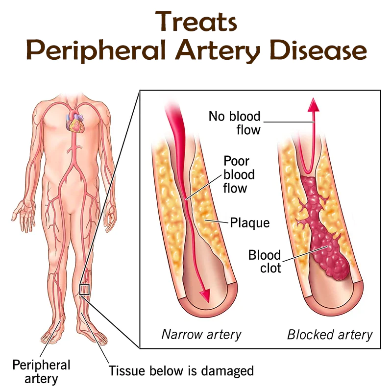 ATTDX Varicose Veins Treatment Cream