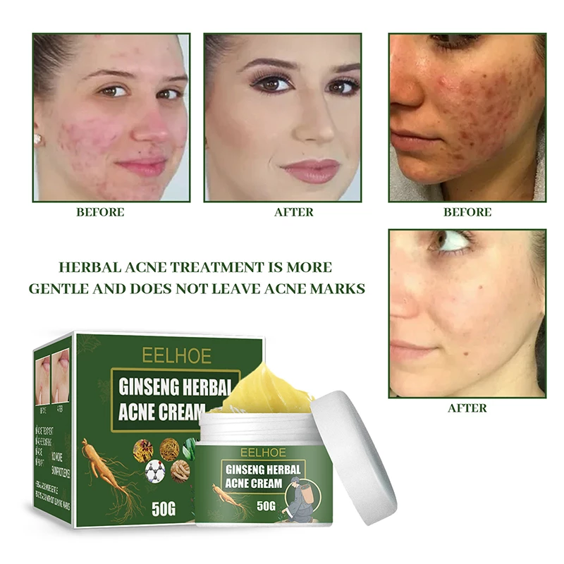 Ginseng Herbal Acne Cream