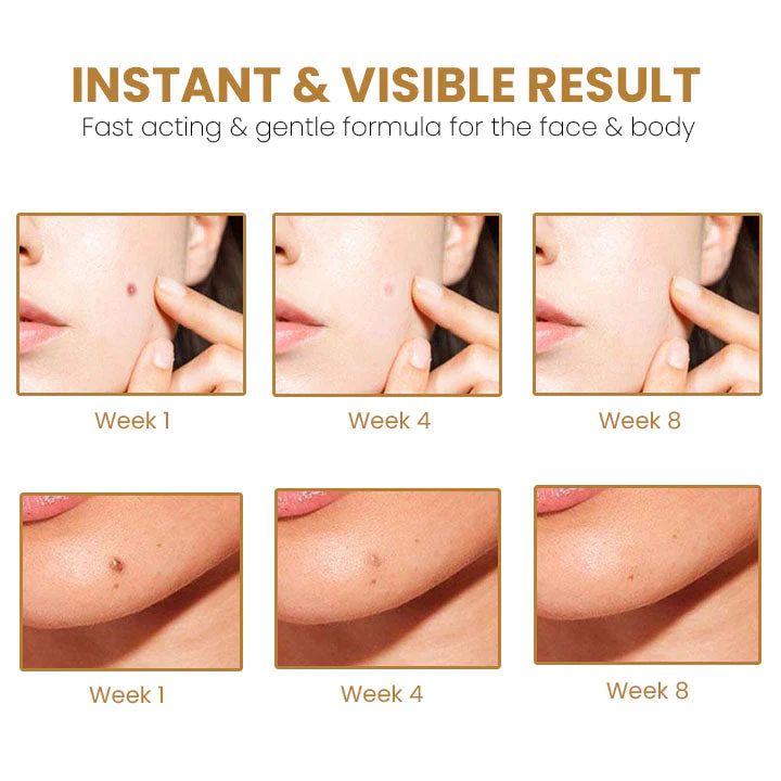 Akemi Dark Spot Solution with Laser Treatment Set