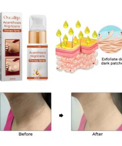 Oveallgo Acanthosis Nigricans Therapy Spray