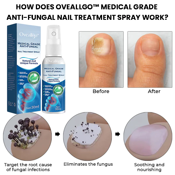 Oveallgo Medical Grade Anti-Fungal Nail Treatment Spray