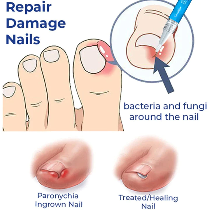 Oveallgo PRO Removal Paronychia Gel