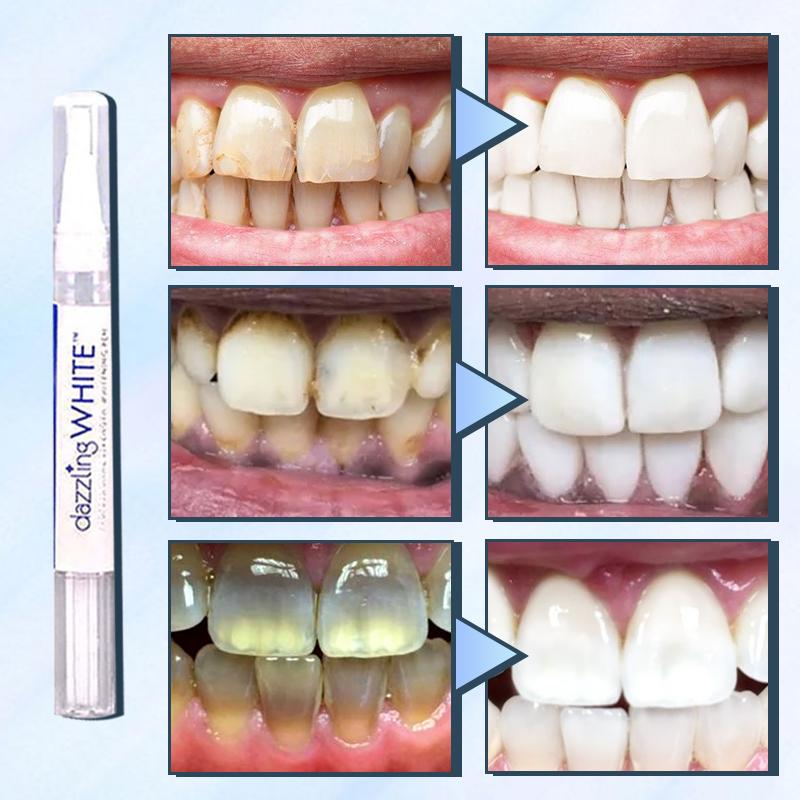 SwipeBright Instant Whitening Oral Pen