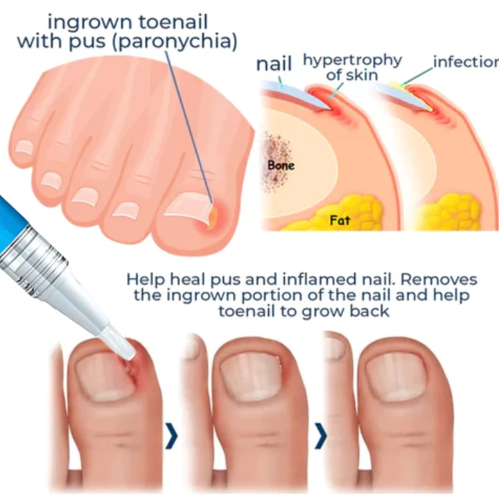 Oveallgo PRO Removal Paronychia Gel