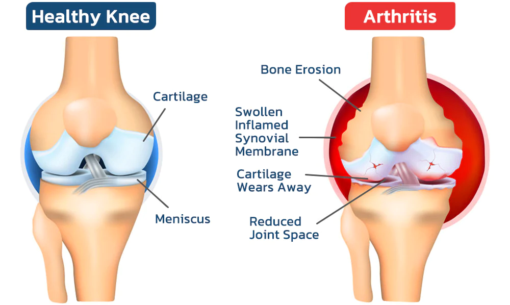 Superb Bone Regeneration Cream