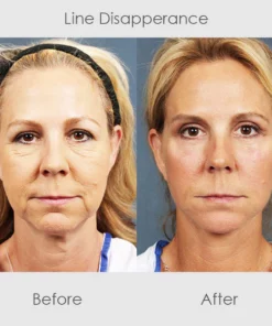 ChaffeeLife Wrinkle Reversing Botox Serum