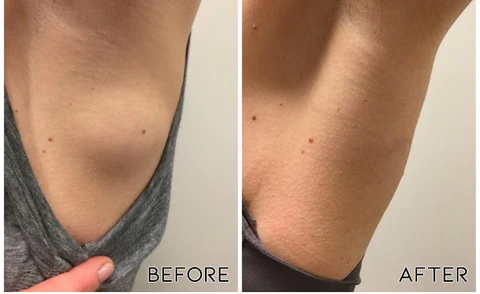 LipoPRO Lipoma Removal CreamLimited Time Discount  Last Day