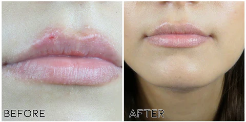 LipClear Cold Sore Honey Patch