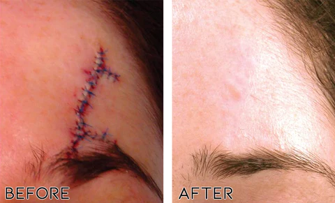 ScarAwayŽ Advanced Medical Silicone Scar Gel