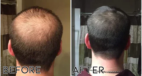 Oveallgo Minoxidil Hair Regrowth Treatment