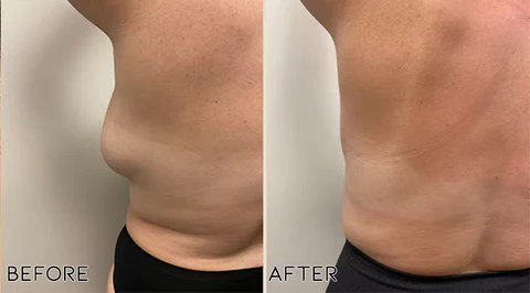 LipoPRO Lipoma Removal CreamLimited Time Discount  Last Day