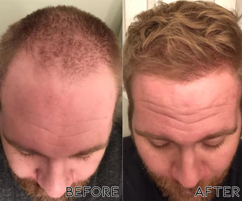 Oveallgo ScalpRevive PRO Minoxidil Growth Roller