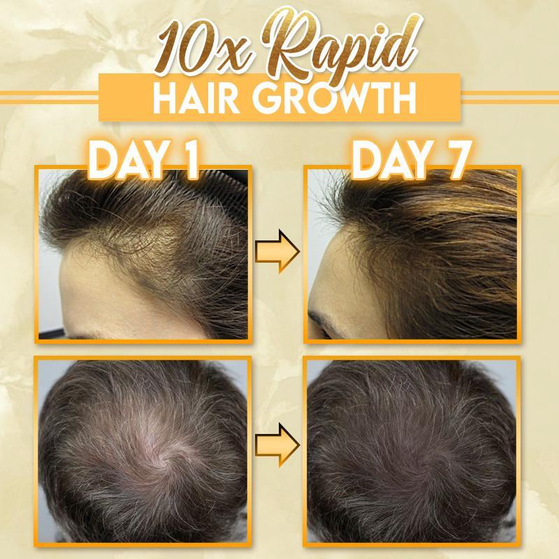 BaldFix Strong Hair Regrowth Serum (¨50%OFF)