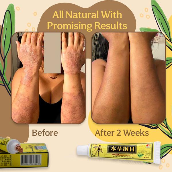 Organic Dermatitis Herbal Healing Cream