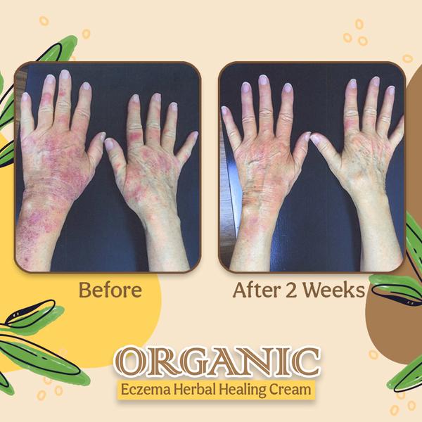 Organic Dermatitis Herbal Healing Cream