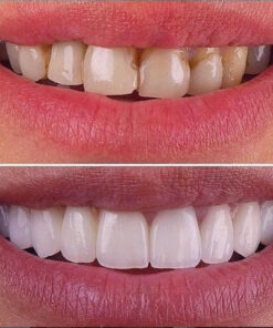 Coconut Oil Teeth Whitening Strips