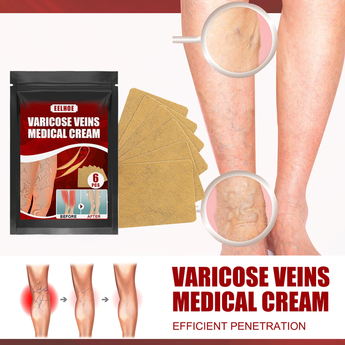 Breakss Varicose Vein Ointment Patch