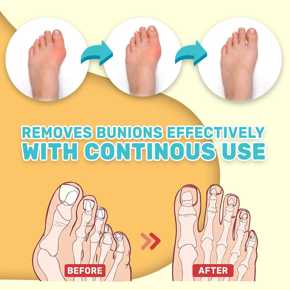 Bunion Toe Stiffness Relief Cream