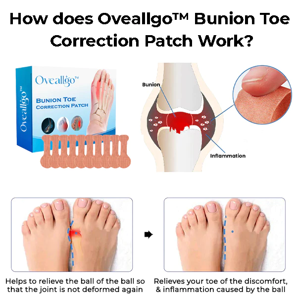 Oveallgo Bunion Toe Correction Patch