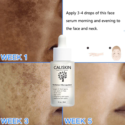 CALISKIN Dark Spot And Acne Treatment Serum Serum