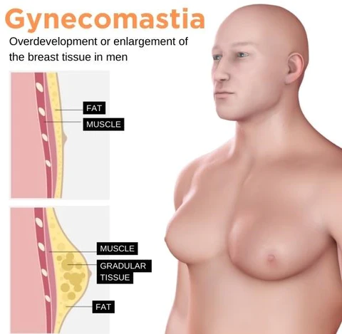 Sculptique Gynecomastia Cream