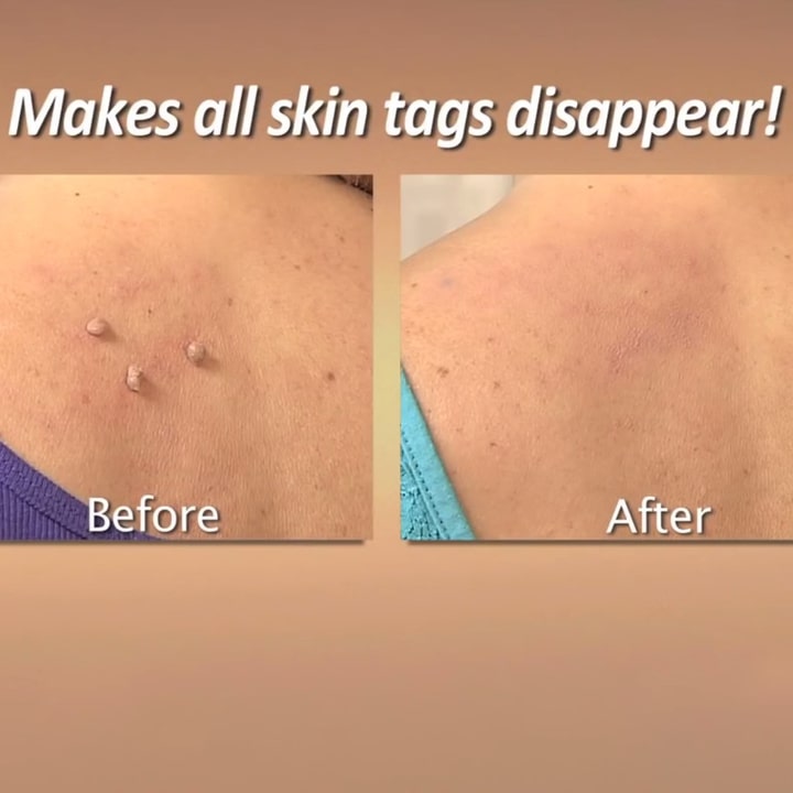 Copper Tag Out Skin Tag Remover