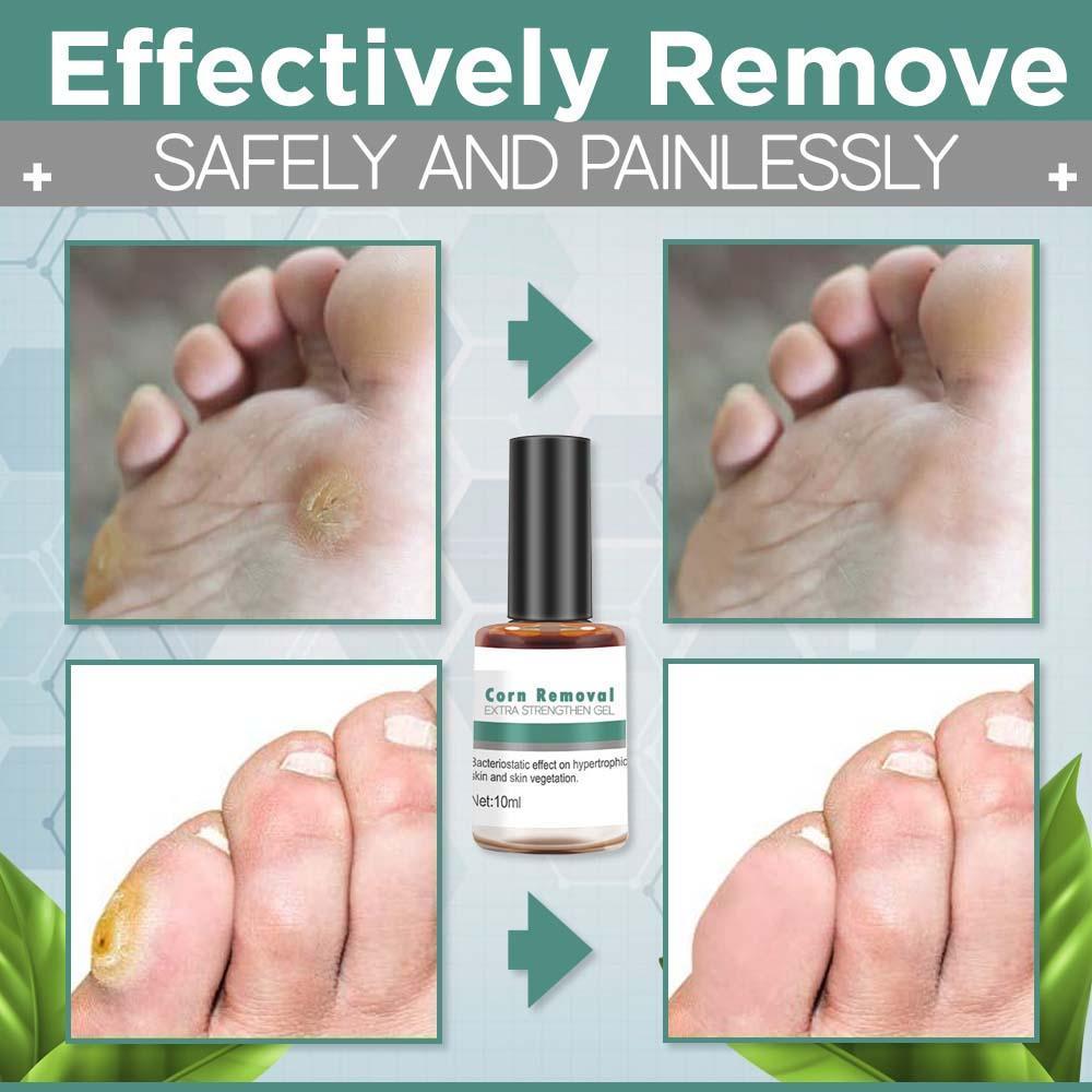 Corn Removal Extra Strengthen Gel